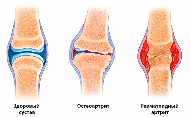 Виды артрита